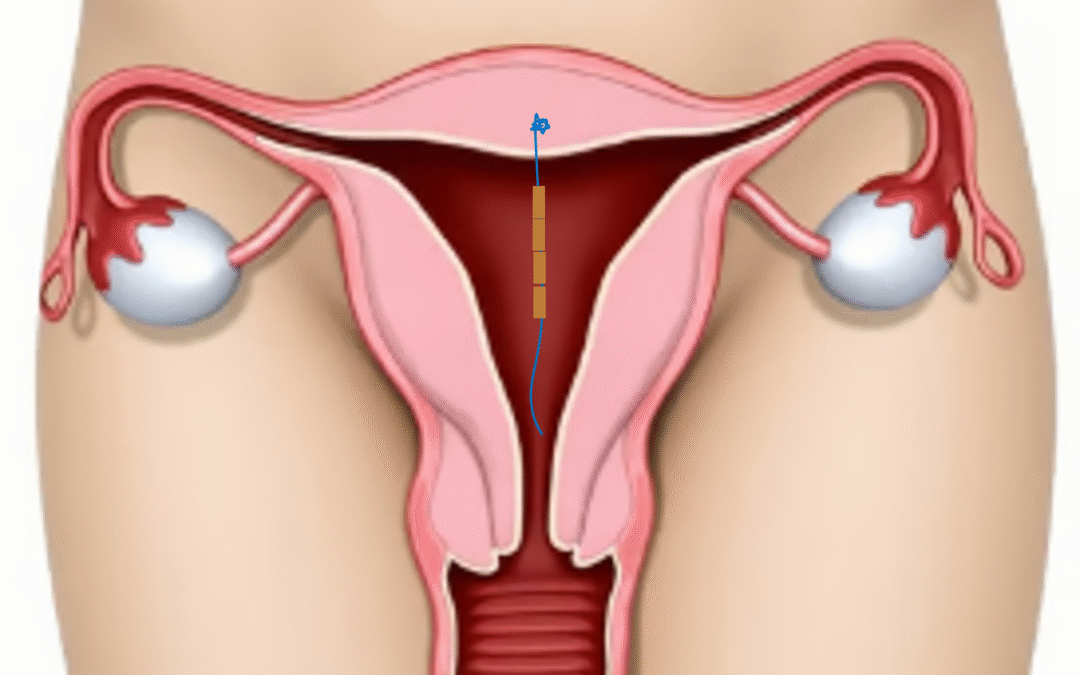 Illustration of the female reproductive system showing GyneFix coil placement within the uterus.