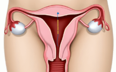 GyneFix® Coil. A Unique, Modern IUD Option
