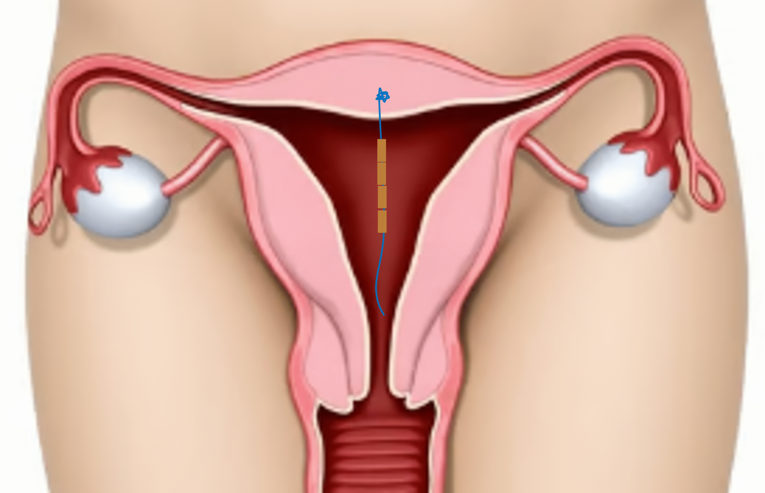 Illustration of the female reproductive system showing GyneFix coil placement within the uterus.