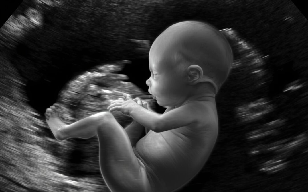 Down Syndrome 12-Week Scan: What Expectant Parents Need to Know