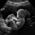 12-week pregnancy ultrasound image showing a fetus in profile with clear views of the head, neck, and torso, used to assess Nuchal Translucency (NT), Crown–Rump Length (CRL), Head Circumference (HC), and Biparietal Diameter (BPD) during first-trimester screening at Holistic Gynaecology Clinic London.