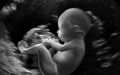 Down Syndrome 12-Week Scan: What Expectant Parents Need to Know