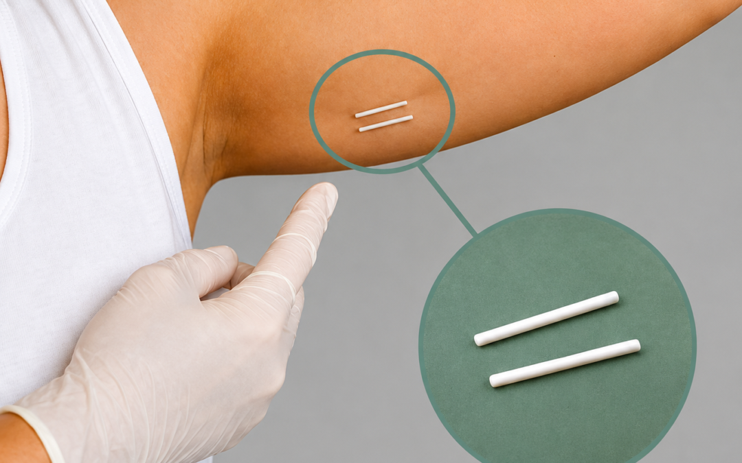 Holistic Gynaecology Clinic London removing a contraceptive implant from the upper arm, including one-rod UK implants and two-rod implants commonly inserted in South America.