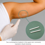 Holistic Gynaecology Clinic London removing a contraceptive implant from the upper arm, including one-rod UK implants and two-rod implants commonly inserted in South America.