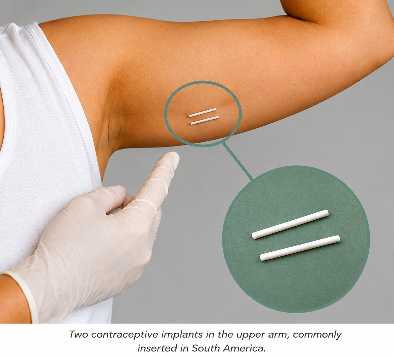 Holistic Gynaecology Clinic London removing a contraceptive implant from the upper arm, including one-rod UK implants and two-rod implants commonly inserted in South America.